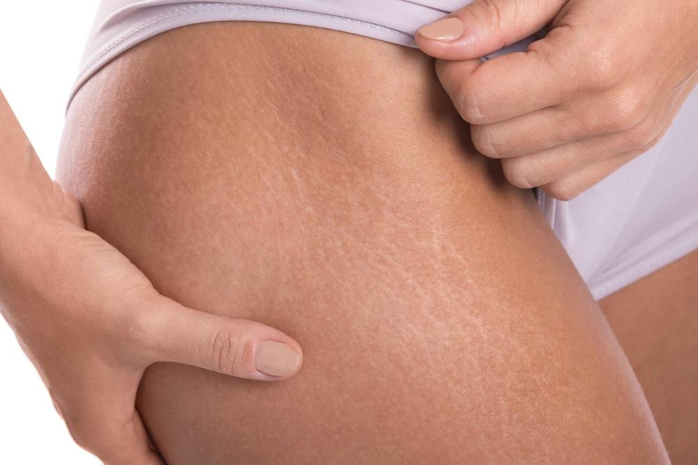 The 3 WHATs of Stretch Marks